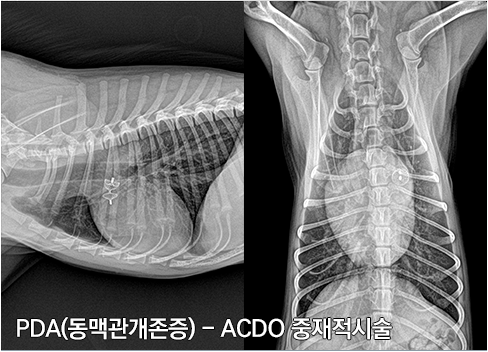 PDA-동맥관개존증-ACDO중재적시술